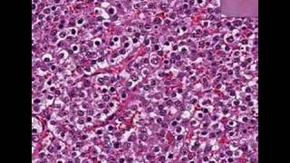 Histopathology Testis Seminoma [upl. by Sibella]