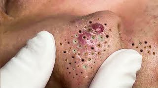 Big Cystic Acne Blackheads Extraction Blackheads amp Milia Whiteheads Removal Pimple Popping  1238 [upl. by Anaira]