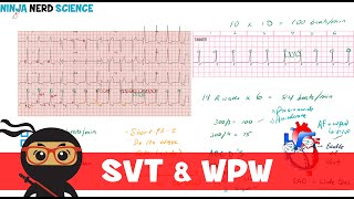 Rate and Rhythm  Supraventricular Tachycardia SVT and WolffParkinsonWhite WPW Syndrome [upl. by Atikram218]