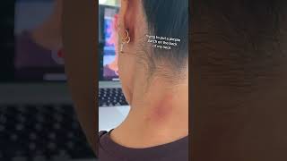 Girl is trying to put a pimple patch on the back of her neck using the screen share featur [upl. by Papageno]