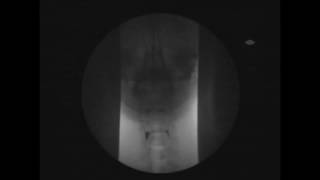 VFS  Videofluoroscopy Assessment of Swallowing  Röntgen Schluckakt [upl. by Portwin]