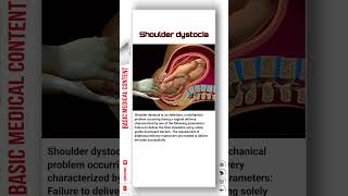 Shoulder Dystocia shoulder shoulderdystocia pregnancy [upl. by Aldus201]