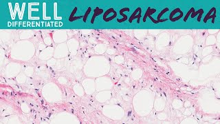 Well differentiated liposarcoma aka atypical lipomatous tumor pathology sarcoma soft tissue tumor [upl. by Aed]