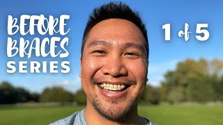 5 THINGS TO KNOW BEFORE GETTING BRACES  Braces Journal [upl. by Ahsienyt]