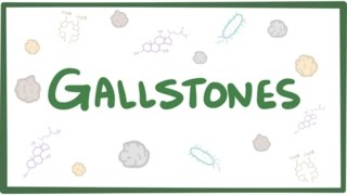 Gallstones cholelithiasis [upl. by Lourie]