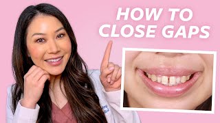 How to Close Gaps in Teeth  Cosmetic Dentist Explains [upl. by Arok837]