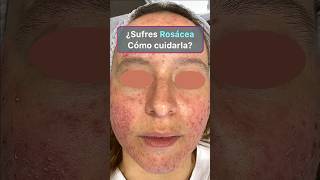 Los 4 mejores tratamientos de la rosácea rosacea rosaceaskincare [upl. by Samala]