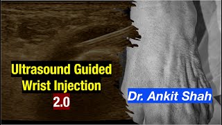 Ultrasound Guided Wrist Injection in Rheumatoid Arthritis  Dr Ankit Shah  MSK Ultrasound [upl. by Enitsirhc]