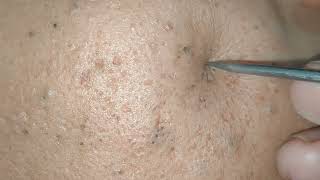 blackheads removal 2023  sac dep spa blackheads removal 2023  skin treatments sac dep spa 2023 [upl. by Mik]