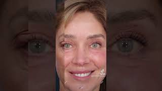 Reawakening Radiance Before and After Eyelid Lift Surgery [upl. by Schreiber976]