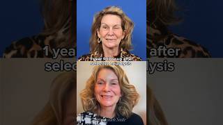 1 year follow up after selective neurolysis facialparalysis synkinesis acousticneuroma [upl. by Olatha182]