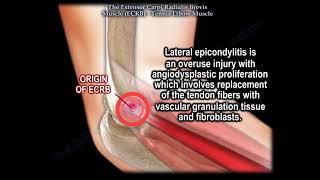 Tennis Elbow Muscle Extensor Carpi Radialis Brevis Everything You Need To Know Dr Nabil Ebraheim [upl. by Yelrebma57]