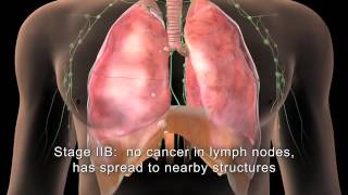 English MAKNA Getting to know Lung Cancer [upl. by Ahsram]