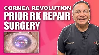 Corneal RK Radial Keratotomy Repair with Topographic Guided Ablation [upl. by Abdul]