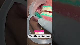 Step By Step Teeth Whitening Process  Happy Smiles Dental Care  DCH [upl. by Eintruoc]