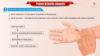 PULSES IN AORTIC STENOSIS  Usmle Cardiology [upl. by Annas]