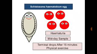 Urine Analysis 17 Schistosoma haematobium eggs [upl. by Melc]