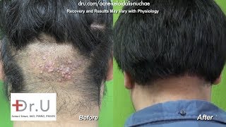 barbers rash back of head Acne Keloidalis Nuchae AKN cure [upl. by Fanestil]