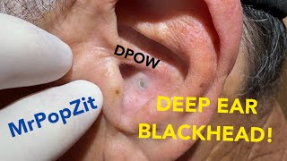 DPOW with firm blackhead lodged deep in ear Keratin pocket expressed just behind ear pearlMust see [upl. by Nynahs461]