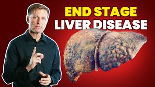 10 Signs of a Dying Liver End Stage Liver Disease [upl. by Doraj908]