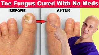 Toe Nail Fungus Cured With No Meds Dr Mandell [upl. by Kelley234]