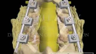 Lumbar Spine Pedicle Screw Fixation Fusion lawyer 3D animations [upl. by Nava]