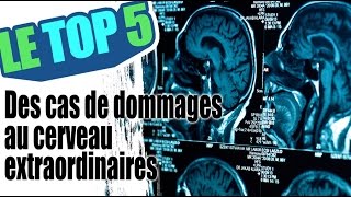 Le top 5 des cas de traumatisme au cerveau extraordinaires [upl. by Scoville600]