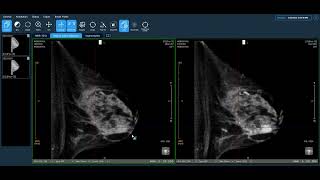 Koning Clinical Overview Invasive Ductal Carcinoma with DCIS Calcifications and Mass [upl. by Varian]