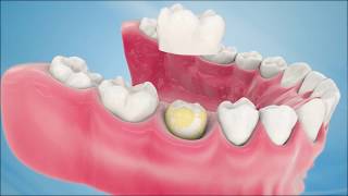 Dental Crown Procedure [upl. by Sholem]