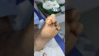 callus Removal treatment Daibetic foot [upl. by Richlad574]