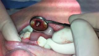 Upper Central Incisor 21 Extraction with Immediate Placement of a NP Nobel Active [upl. by Lennaj]