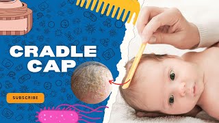 Cradle Cap Explained Pediatricians Tips for Treatment amp Prevention 👶✨🩺 CradleCap Agila [upl. by Rugen]