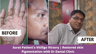 Surat Patients Vitiligo Victory  Restored skin Pigmentation with Dr Danial  vitiligotreatment [upl. by Iren203]