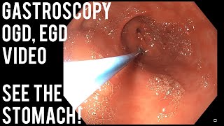 Gastroscopy  OGD  See inside the stomach [upl. by Caprice]