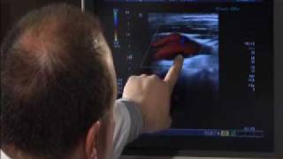 Carotid Artery Ultrasound [upl. by Manville]