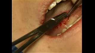 Excisional Biopsy of Tongue Lesion [upl. by Katha285]