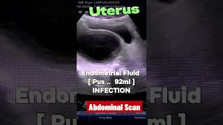 Postmenopausal Uterus  Endometrial Pus  Infection ultrasound infection [upl. by Anitselec]