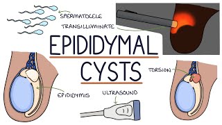 Understanding Epididymal Cysts [upl. by Breen]