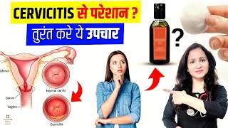 Ayurvedic Treatment For Cervicitis  CERVICITIS TREATMENT  बच्चेदानी के मुख की सूजन  कारण और इलाज [upl. by Brittni]