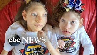 Kansas Parents of 2 Girls With Microcephaly Share Joys Struggles of Family Life [upl. by Aileme]