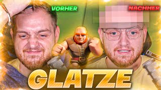 😨🤯GLATZE LIVE RASIERT  HAARTRANSPLANTATION INCOMING [upl. by Oirretna810]