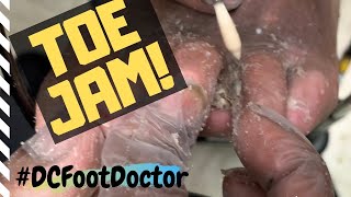 Trimming Fungal Toenails Corns Calluses and Toe Jam Problems of an At Risk Diabetic [upl. by Ijat]