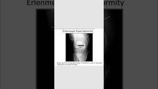 Erlenmeyer flask deformityradiology orthopedics [upl. by Lewendal]