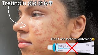 Tretinoin mistakes that ruined my skin 😫 tretinoin skincare beauty [upl. by Childers]