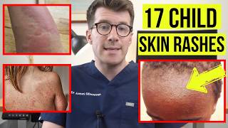 Identifying SKIN RASHES in BABIES and CHILDREN  DOCTOR explains 17 COMMON SKIN CONDITIONS [upl. by Araek]