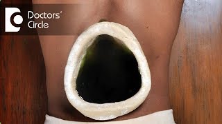 Ayurvedic treatment for Slip Disc  Dr Prashanth S Acharya [upl. by Claiborne]