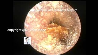 Care should be taken in case of cerumen with tympanic membrane perforation [upl. by Neveda]