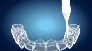 Tooth Whitening  Home Bleaching [upl. by Carol]