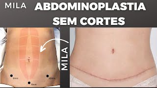 ABDOMINOPLASTIA SEM CORTES e sem cicatrizes Mínimamente invasiva é POSSÍVEL SIMMMM É POSSÍVEL [upl. by Enelrad]