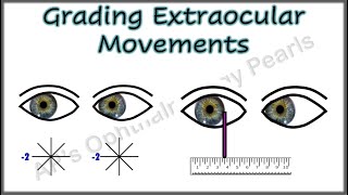 Grading Extraocular Movements [upl. by Anaugal]